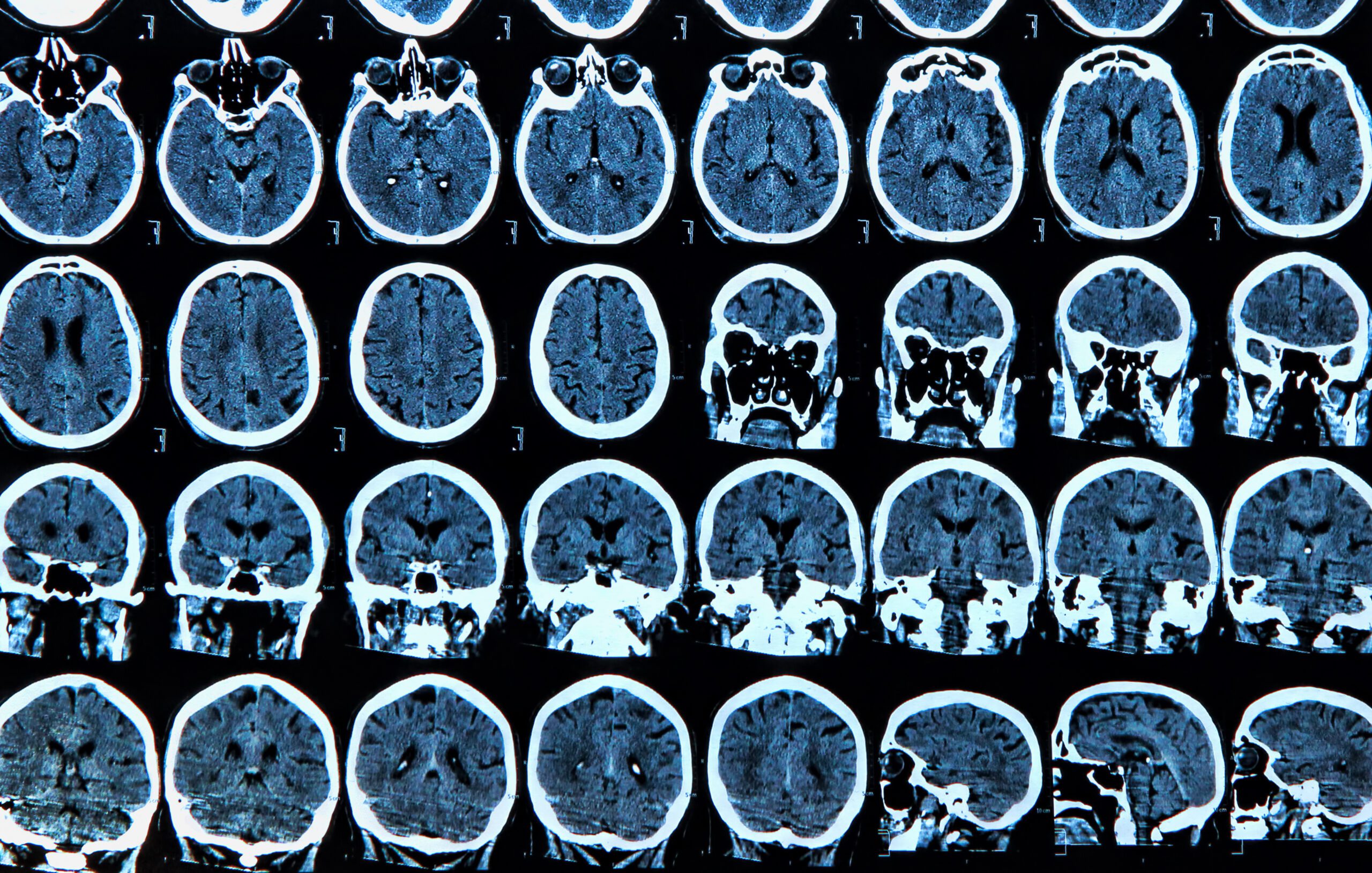 MRI scan of the human brain